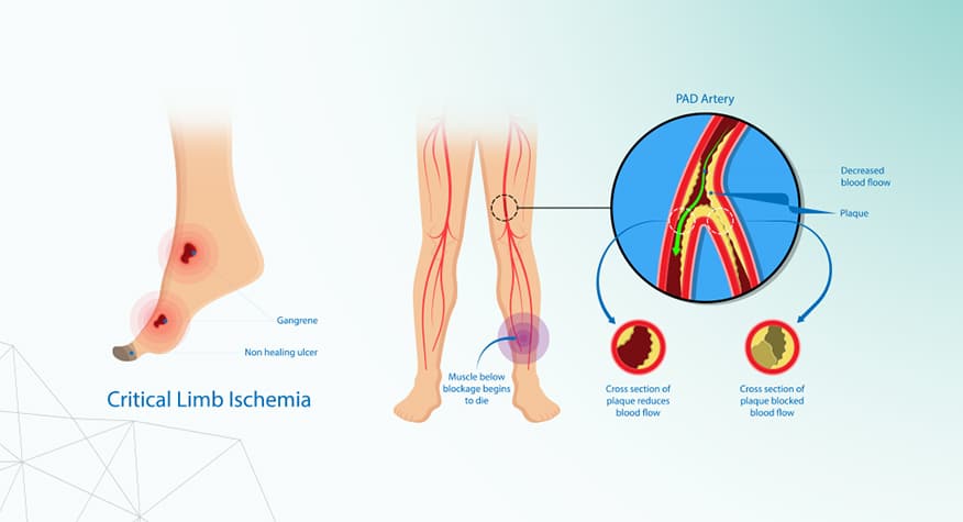 venous ulcer vs arterial ulcer