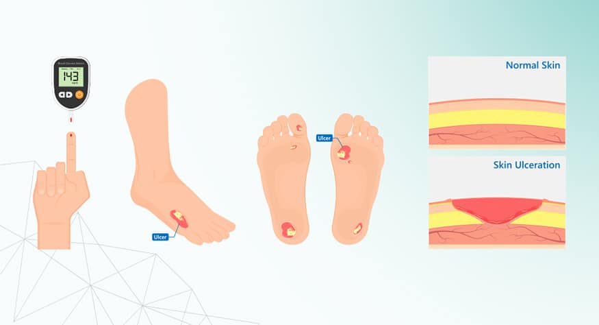 Nivaran Health - What is Diabetic Foot Ulcer ?? 🦶🏼... | Facebook