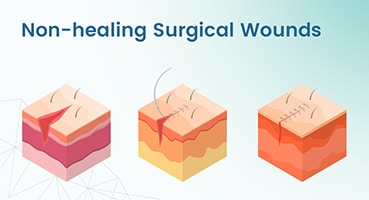 Non-healing Surgical Wounds - EKare Inc.